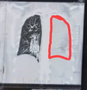 no lung tissue on left side.