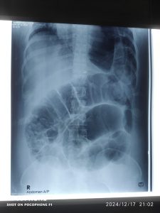 Second x-ray 